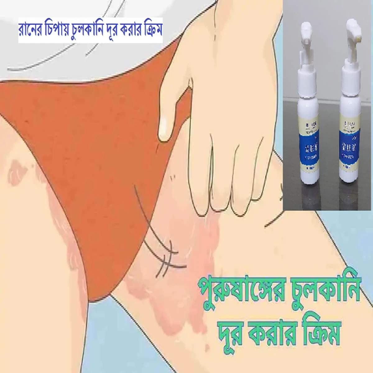 Antibacterial Cream (১০০% কার্যকর প্রডাক্ট)-ফুল কোর্স